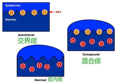 新的痣|为什么身上突然长出新痣？容易恶变吗？